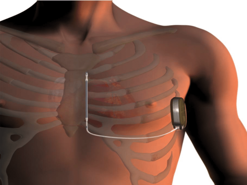 défibrillateur cardiaque implanté